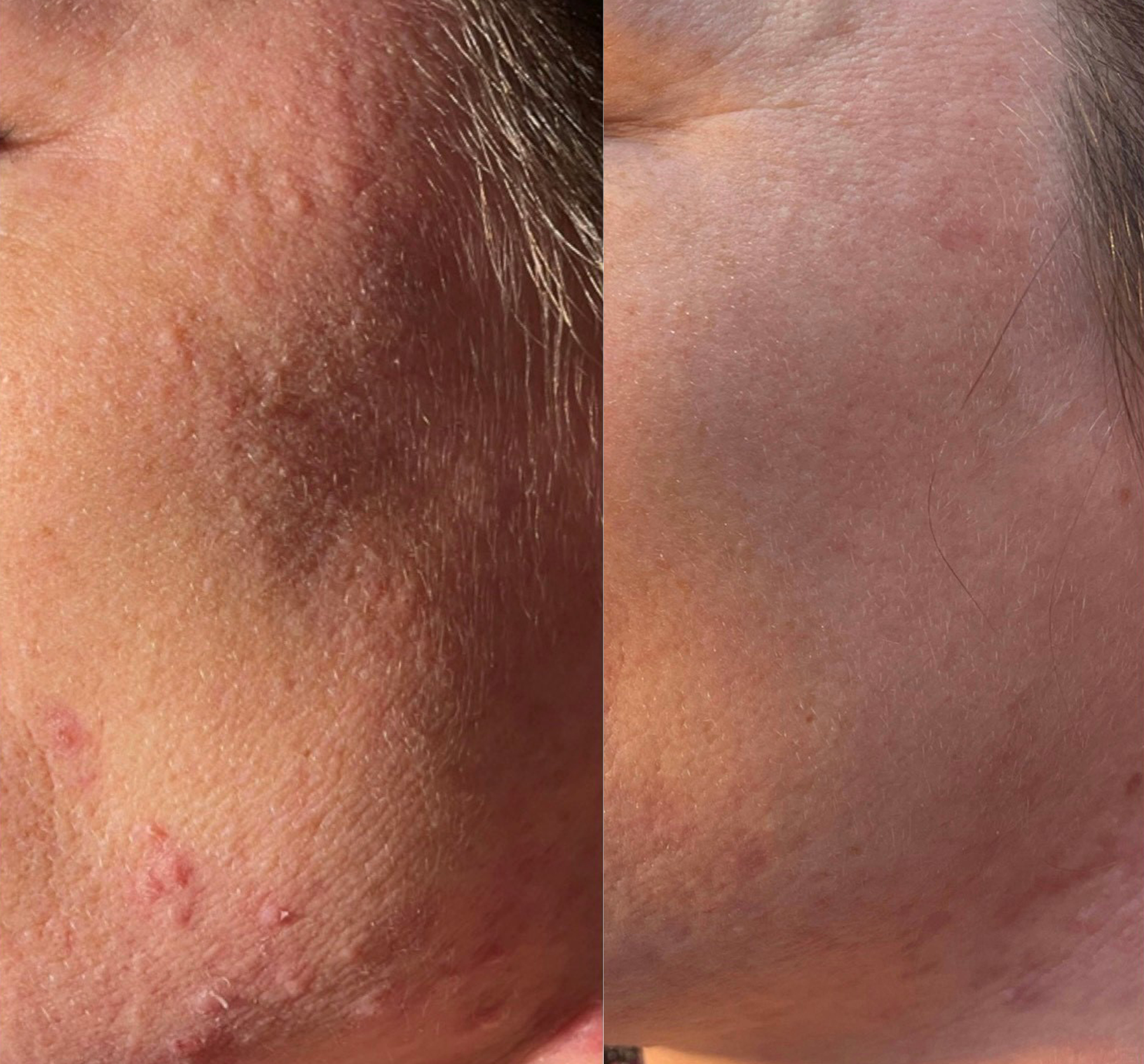 dermaSEMITA Treatment Before and After 1