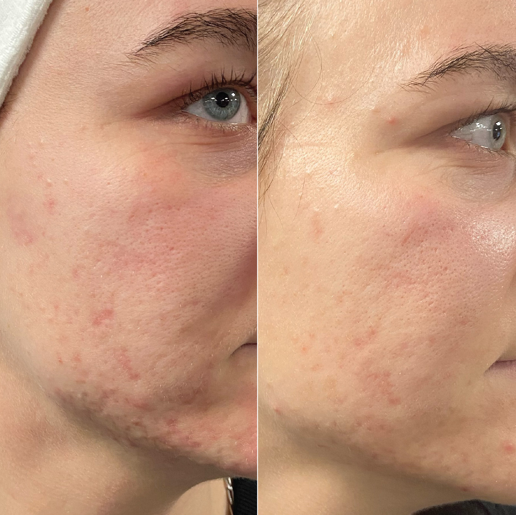 dermaSEMITA Treatment Before and After 2