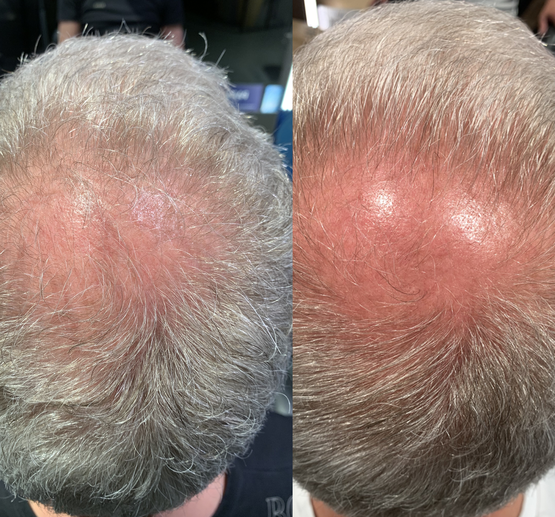 dermaSEMITA Treatment Before and After 3