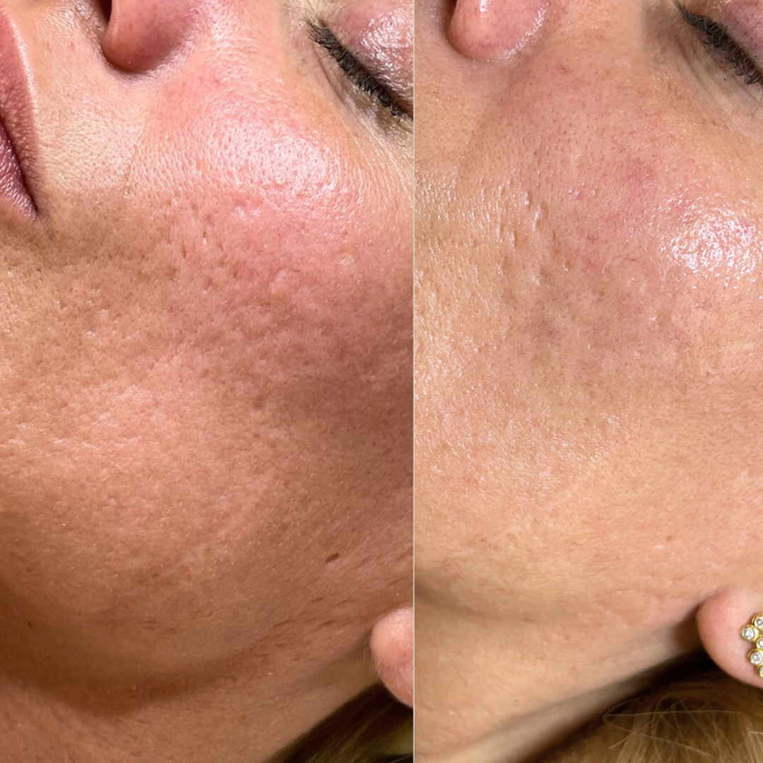 dermaSEMITA Treatment Before and After 4