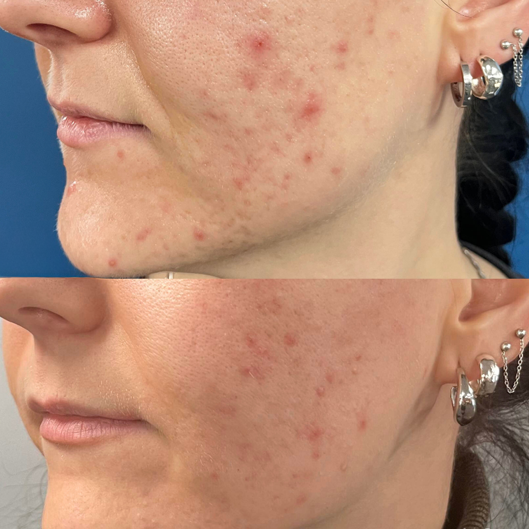 dermaSEMITA Treatment Before and After 5
