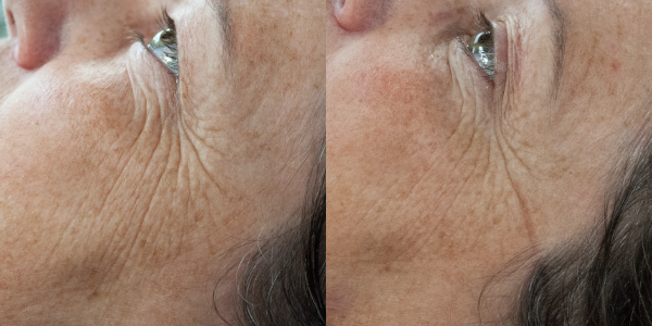 dermaSEMITA Treatment Before and After 6