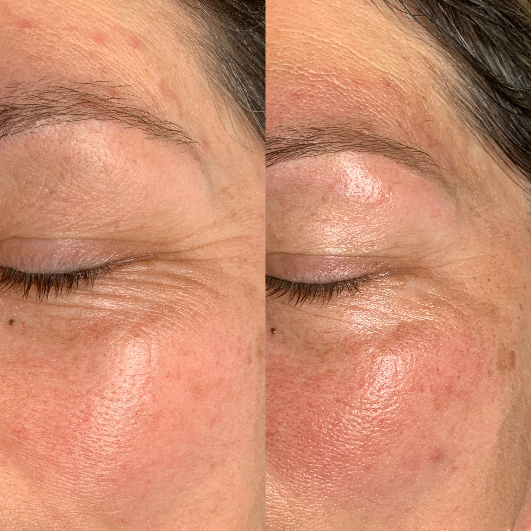 Oxygen Treatment Before and After 2