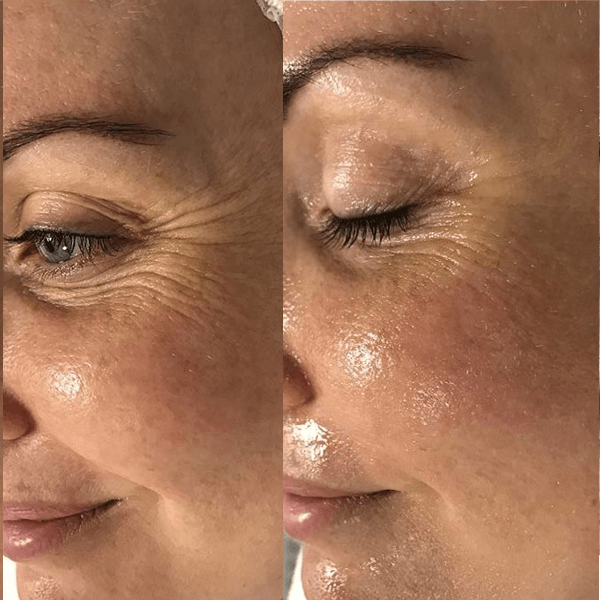 Oxygen Treatment Before and After 3