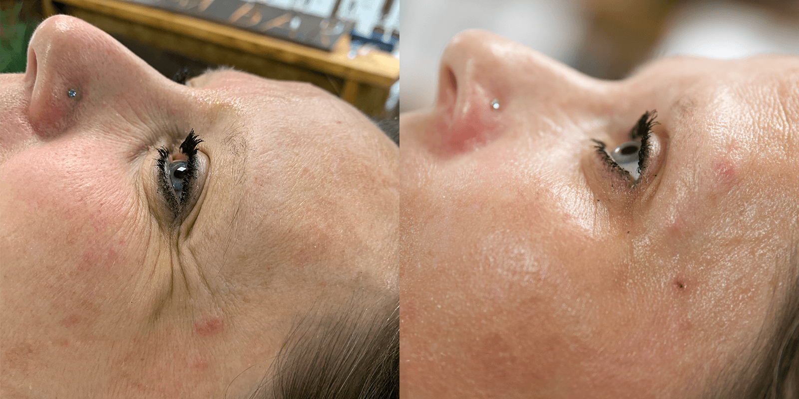 Oxygen Treatment Before and After 6