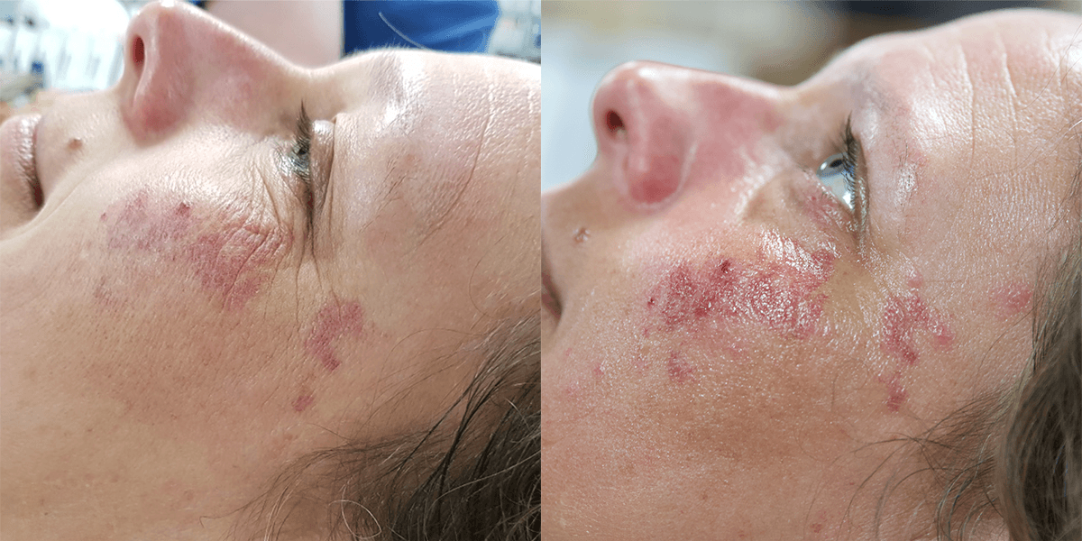 Oxygen Treatment Before and After 7