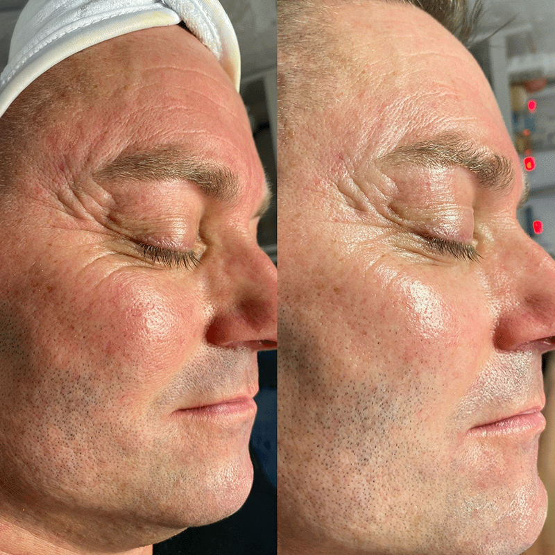 Oxygen Treatment Before and After 4