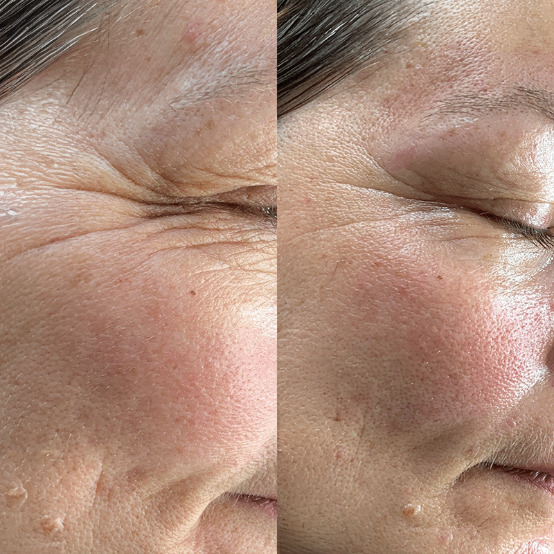 Oxygen Treatment Before and After 1