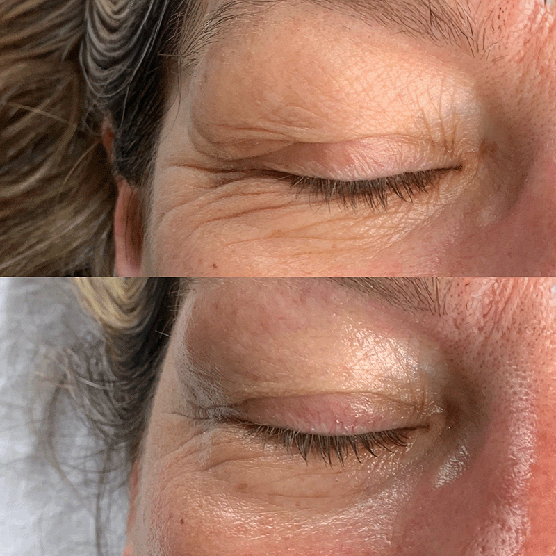 Oxygen Treatment Before and After 5